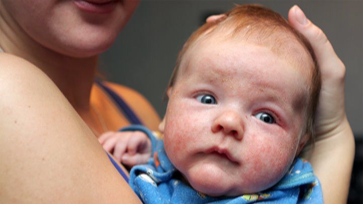An Essential Guide to Baby Eczema