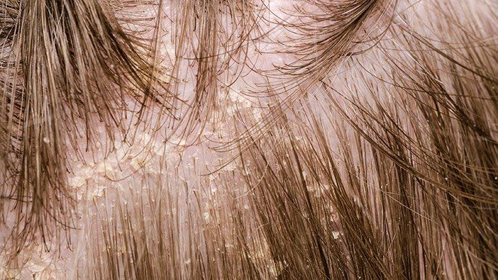 A Detailed Guide to Scalp Eczema