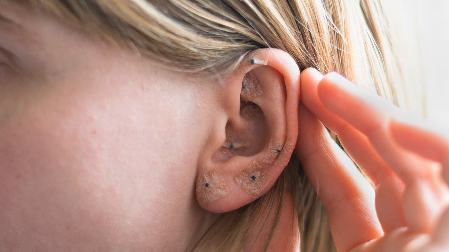 Ear Seeds: How This Acupressure Therapy May Enhance Your Overall Wellness
