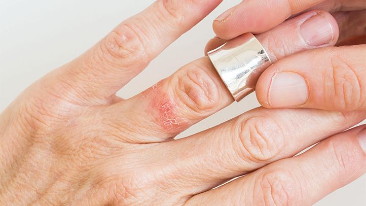 hand ring contact-dermatitis