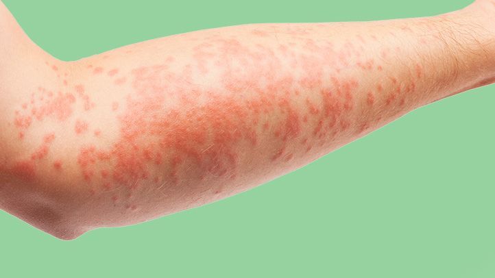 atopic dermatitis on an arm